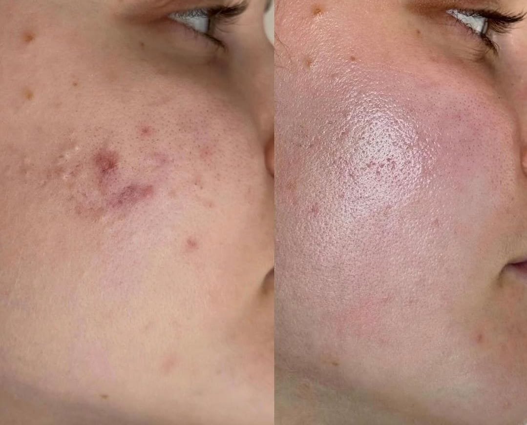 Before and after Acnipure facial treatment