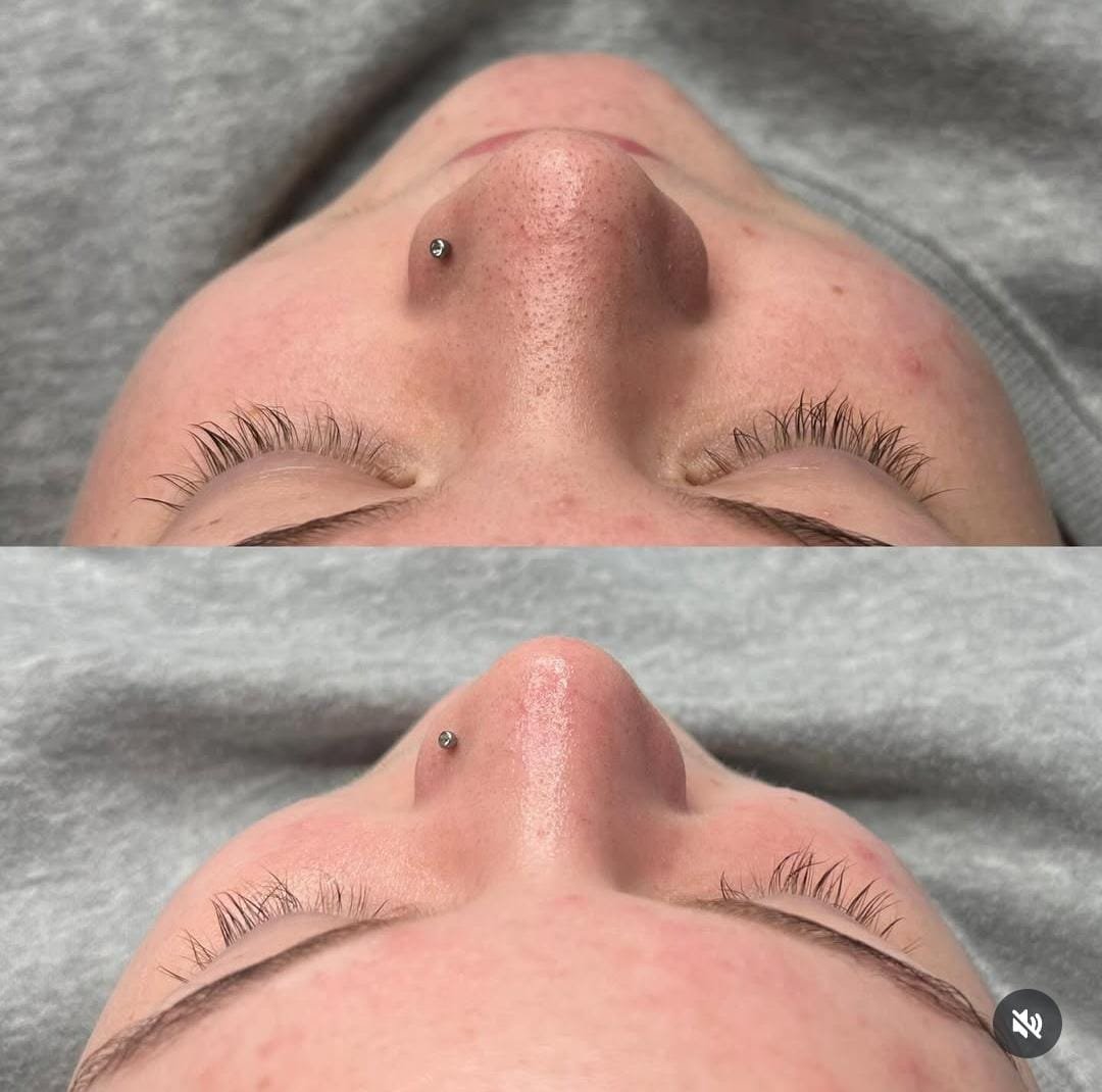 Before and after Deep Detox facial treatment