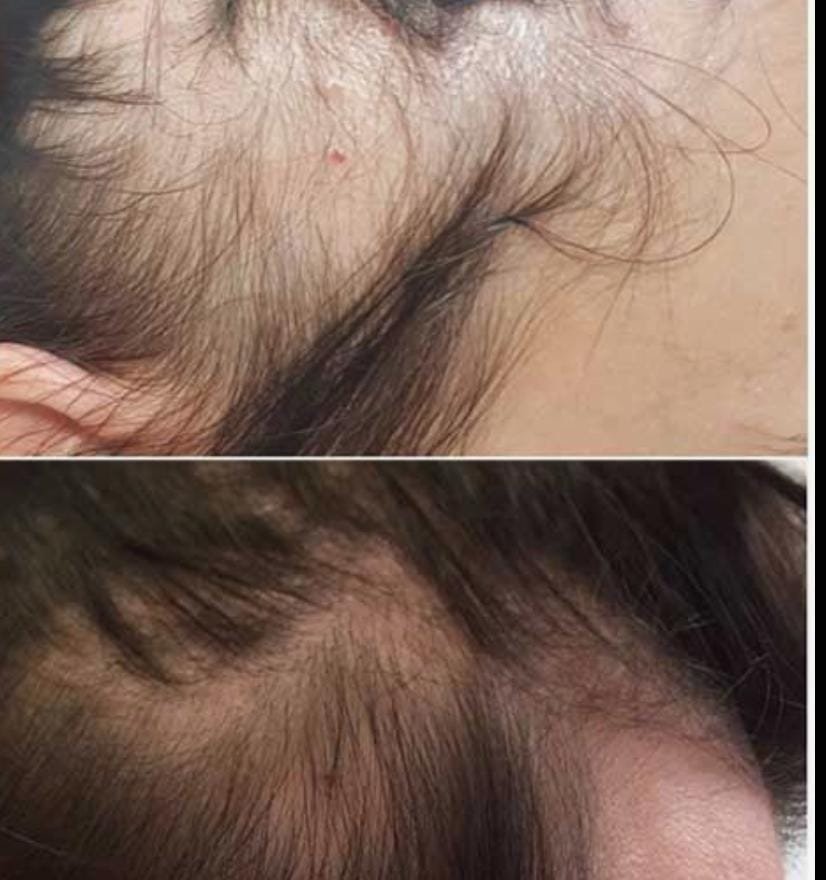 Before and after Grow Max hair treatment